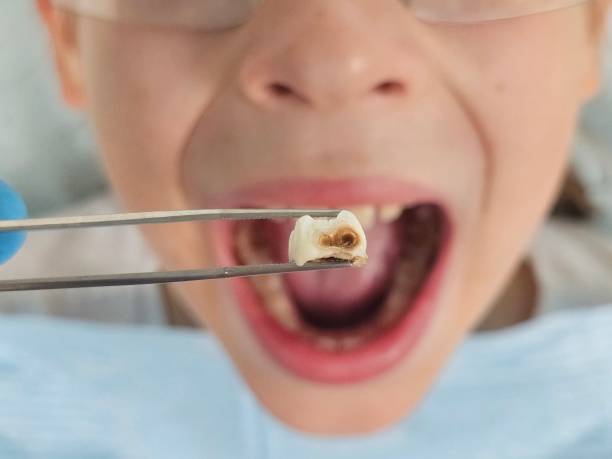 Best Emergency Dental Extractions in USA